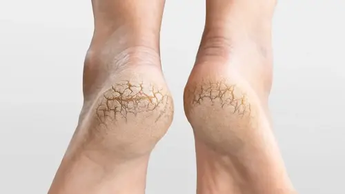 Трещины на пятках — как вернуть коже мягкость